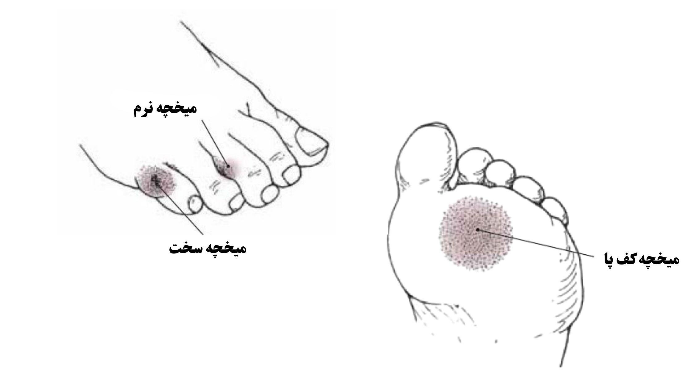 انواع میخچه پا